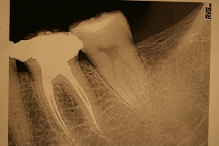 Before After Failed Molar Root Canal Treatment - Re-root filling after copious irrigation/ cleaning 